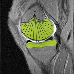 ARTICOLAZIONE FEMORO TIBIALE 009 osce spine center