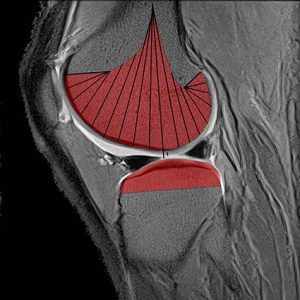 ARTICOLAZIONE FEMORO TIBIALE 010 osce spine center