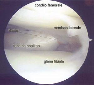 ARTICOLAZIONE FEMORO TIBIALE 014 osce spine center