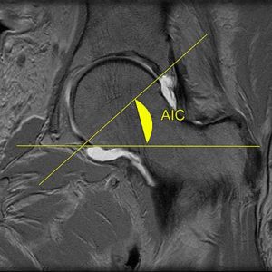 ARTICOLAZIONE ANCA 016 osce spine center