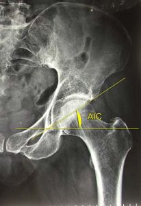 ARTICOLAZIONE ANCA 017 osce spine center