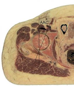 ARTICOLAZIONE ANCA 018 osce spine center