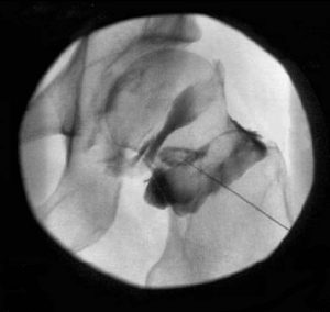 ARTICOLAZIONE ANCA 024 osce spine center