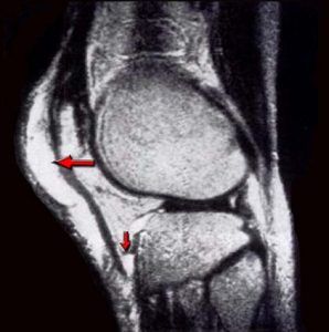 MUSCOLI GINOCCHIO 014 osce spine center