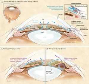 Osteopatia e Glaucoma trattamento sconosciuto 010 osce spine center