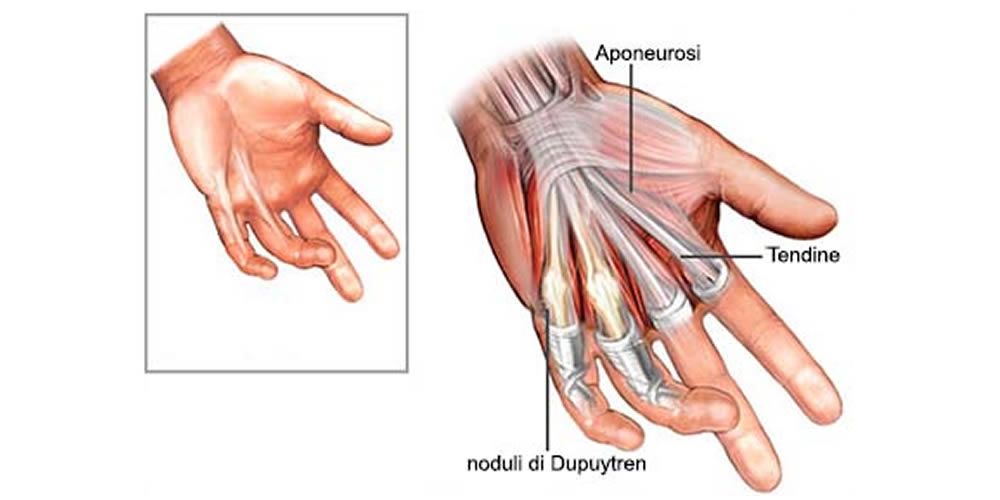 Malattia di Dupuytren